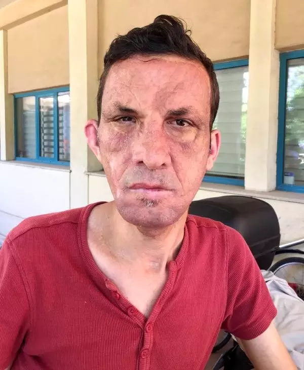 4'üncü çift kol nakli Antalya'da yapıldı (3) 4'üncü çift kol nakli Antalya'da yapıldı (3)