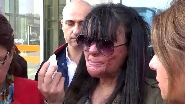 Yüzüne asit atılan Berfin: Kadına şiddet nihayet bulsun