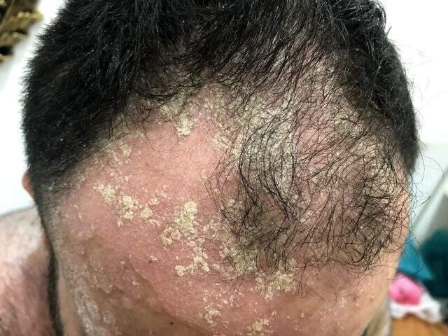 Tüm vücudunu sedef saran hasta derdine Ankara'da çare arıyor