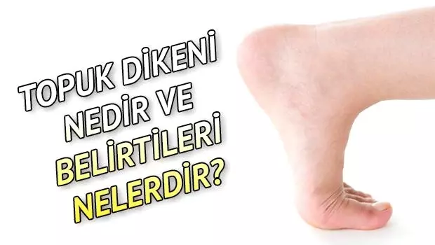 Topuk dikeni nedir? Topuk dikeni belirtileri nelerdir?