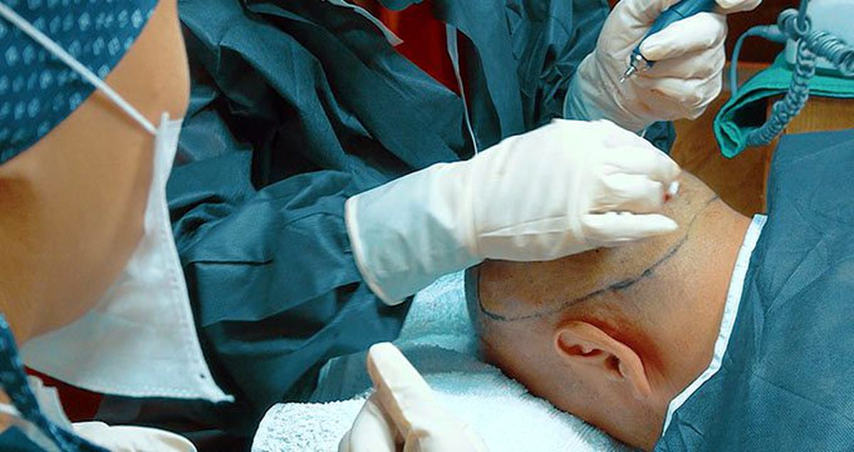 Saç ekiminde 'Seyyar ekimciler' ortaya çıktı