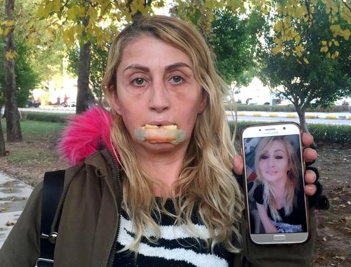 Güzellik uğruna hayatı karardı! Talihsiz kadın tanınmaz hale geldi