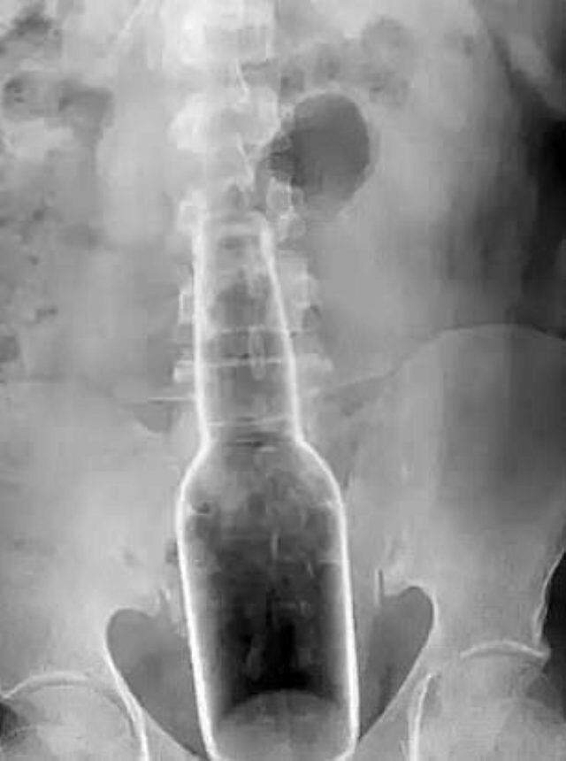 Doktorlar bile şaşırdı! Hastanın anüsünden 18 santimetre uzunluğunda, 5 santimetre kalınlığında şişe çıkarıldı