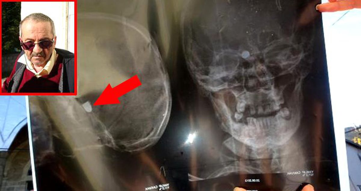 47 yıldır başındaki maganda kurşunuyla yaşayan talihsiz adam: Artık bu acıya katlanamıyorum