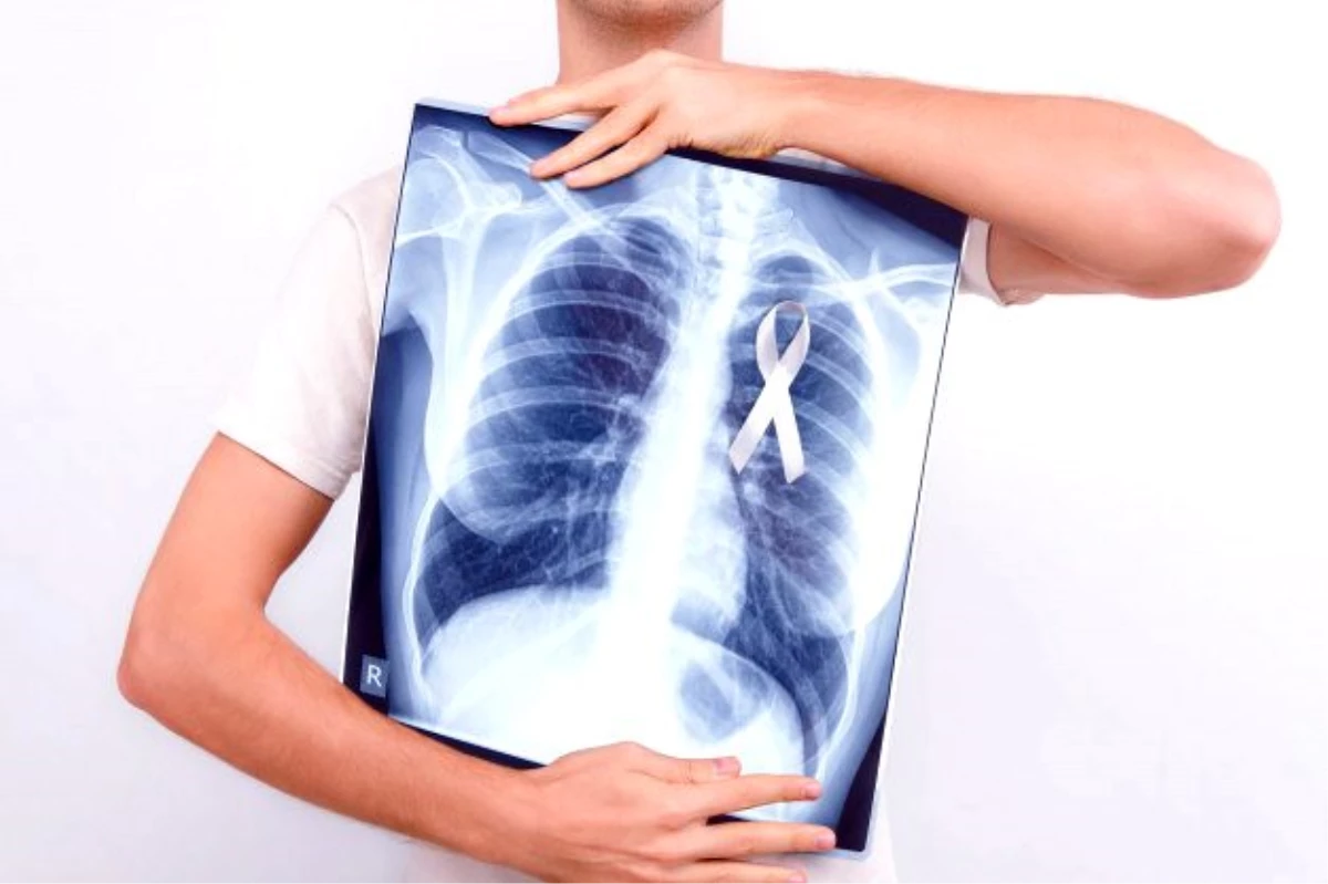 Akciğer kanseri tedavisi kişiye özel planlanmalıdır - Haber