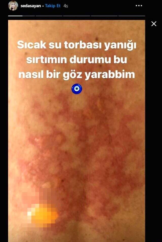 Seda Sayan'ın sırtında sıcak su torbası patladı