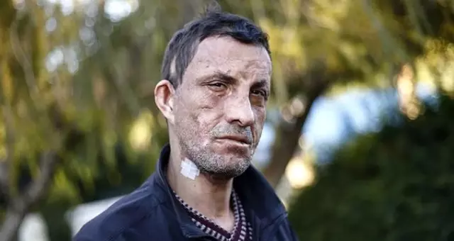 Türkiye'nin ilk yüz nakillisi Uğur Acar: Tek isteğim evlenmek Türkiye'nin ilk yüz nakillisi Uğur Acar: Tek isteğim evlenmek