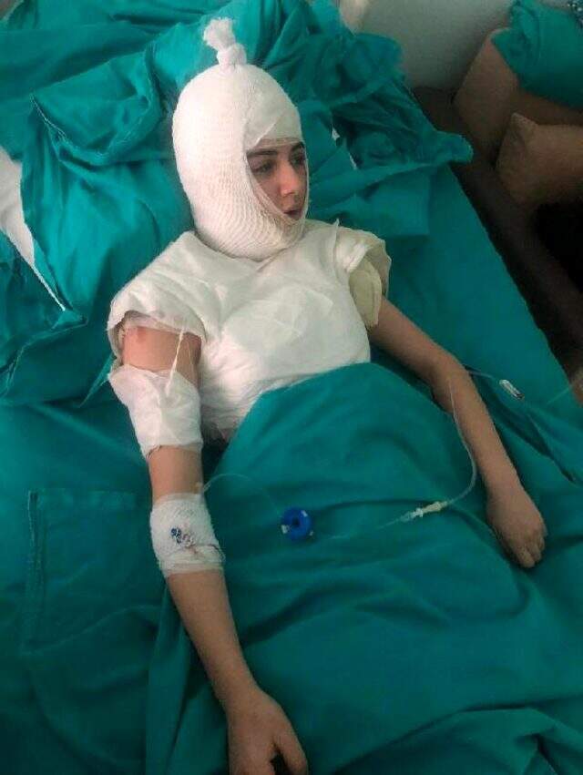 Üvey anne dehşeti! 14 yaşındaki kızın başından aşağı kaynar su döktü