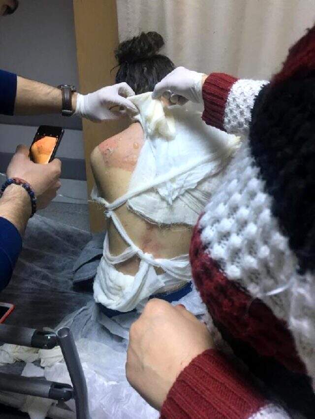 Üvey anne dehşeti! 14 yaşındaki kızın başından aşağı kaynar su döktü