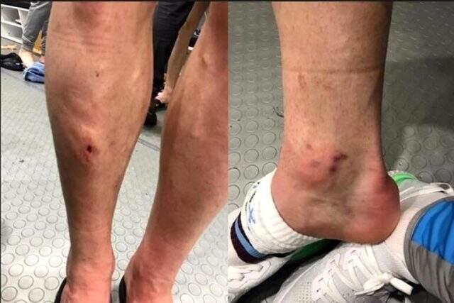 Alexander Sörloth'un bacağının görüntüsü sosyal medyayı salladı