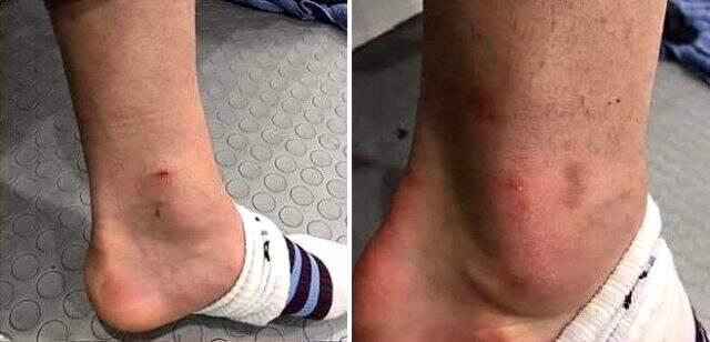 Alexander Sörloth'un bacağının görüntüsü sosyal medyayı salladı