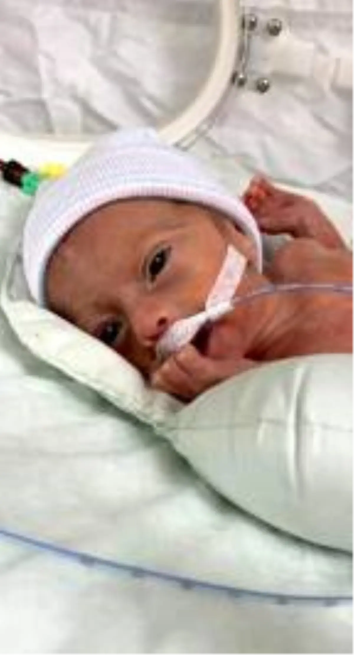 İsveçli bebek Alicia�nın tedavisi, Akdeniz Üniversitesi