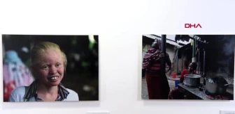 Kara kıtanın beyaz çocukları?: afrikalı albinoların dramı sanatseverlerle buluştu