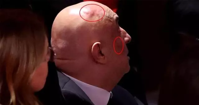 Meclis'teki yumruklu kavga sonrası CHP'li Engin Özkoç'un kafasında ve yüzünde şişlik oluştu Meclis'teki yumruklu kavga sonrası CHP'li Engin Özkoç'un kafasında ve yüzünde şişlik oluştu