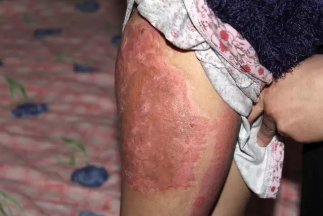 Depremde yanmıştı, küçük kız yapay ve kendi derisinin nakli ile tedavi edildi Depremde yanmıştı, küçük kız yapay ve kendi derisinin nakli ile tedavi edildi