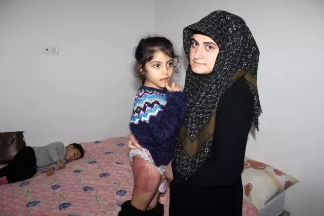 Depremde yanmıştı, küçük kız yapay ve kendi derisinin nakli ile tedavi edildi Depremde yanmıştı, küçük kız yapay ve kendi derisinin nakli ile tedavi edildi