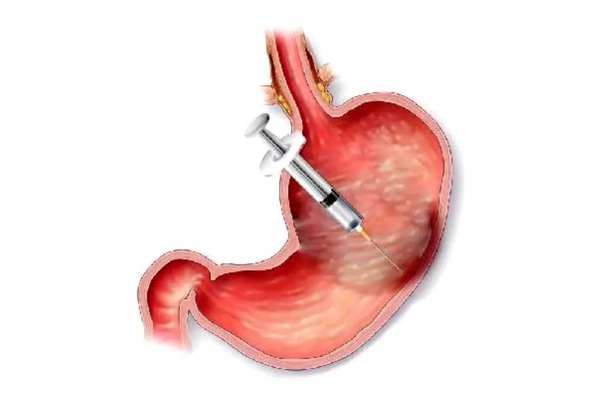 Kilolarinizdan Mide Botoksu Ile Kurtulun Haberler