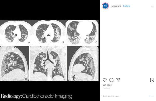 Koronavirüs salgını nedeniyle hayatını kaybeden Çin'li adamın röntgen fotoğrafları ortaya çıktı