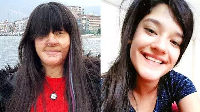 Berfin Özek, hayatını karartan asitli saldırganı affetti Berfin Özek, hayatını karartan asitli saldırganı affetti