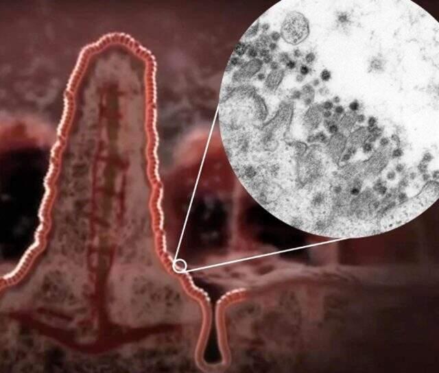 The clearest view of damage! Coronavirus can also multiply in the digestive system.