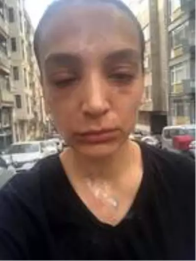 Lavabo açıcı bomba gibi patladı! Kadının yüzünde 2'inci derece yanıklar oluştu Lavabo açıcı bomba gibi patladı! Kadının yüzünde 2'inci derece yanıklar oluştu
