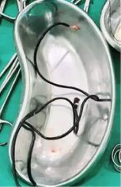 Tıp dünyasını şaşkına çeviren olay! Mesanesinden bir metrelik şarj kablosu çıktı Tıp dünyasını şaşkına çeviren olay! Mesanesinden bir metrelik şarj kablosu çıktı
