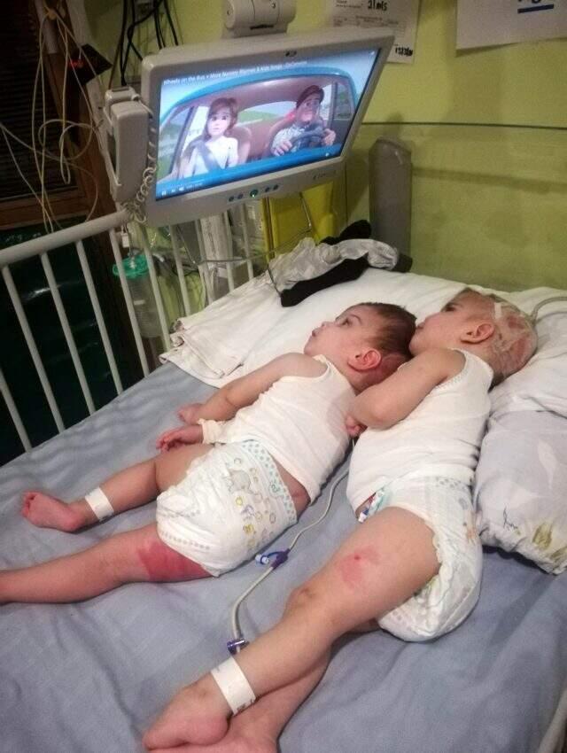 Özel operasyonla birbirlerinden ayrılan Antalyalı siyam ikizlerinden ilk fotoğraf geldi.