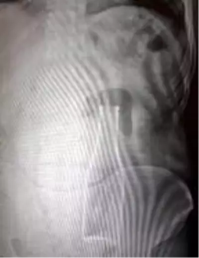 Karın ağrısı şikayetiyle hastaneye giden gencin vücudundan soda şişesi çıktı