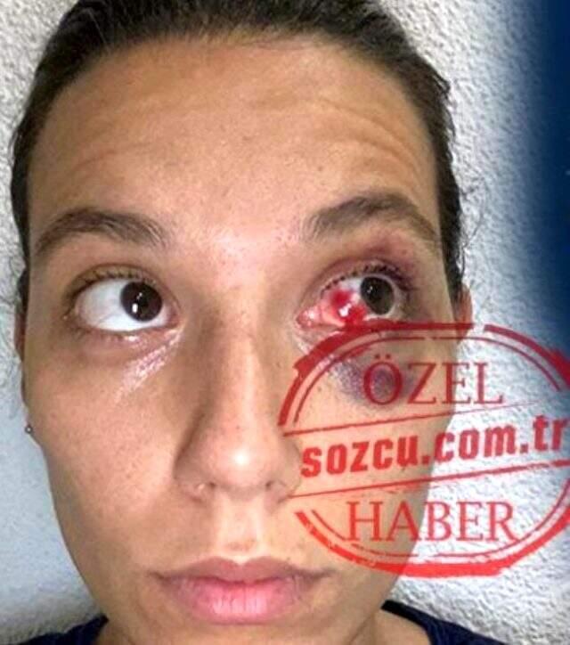 Ozan Güven'den şiddet gördüğünü iddia eden Deniz Mutlutsuz'un darp raporunda onlarca morluk ve çürüğe rastlandı