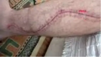 AYDIN Çenesinden 420 gram tümör alınan hasta Sevdiğim kızdan hastalığıma rağmen vazgeçmedim O da... AYDIN Çenesinden 420 gram tümör alınan hasta Sevdiğim kızdan hastalığıma rağmen vazgeçmedim O da...
