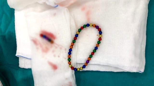 Karın ağrısıyla hastaneye giden çocuğun midesinden 42 adet mıknatıs topu çıktı
