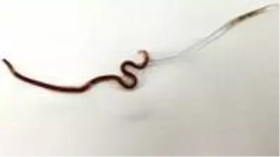 Boğaz ağrısıyla doktora giden kadının bademciğinden kurtçuk çıktı Boğaz ağrısıyla doktora giden kadının bademciğinden kurtçuk çıktı