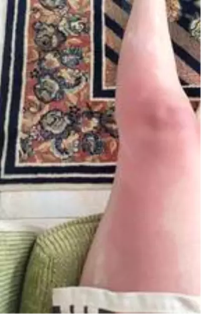 Güneş yanığına kesinlikle bunları sürmeyin Güneş yanığına kesinlikle bunları sürmeyin