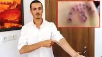 Özel harekatçı olmak için dövmelerini sildirmeye giden gencin cildi çürümeye başladı Özel harekatçı olmak için dövmelerini sildirmeye giden gencin cildi çürümeye başladı