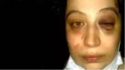 Eski eşi tarafından darp edilen talihsiz kadın her gün ölüm korkusuyla yaşıyor Eski eşi tarafından darp edilen talihsiz kadın her gün ölüm korkusuyla yaşıyor