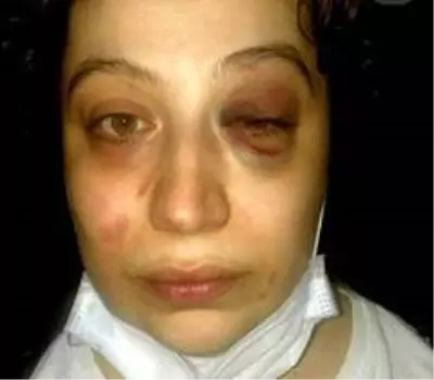 Eski eşi tarafından darp edilen talihsiz kadın her gün ölüm korkusuyla yaşıyor Eski eşi tarafından darp edilen talihsiz kadın her gün ölüm korkusuyla yaşıyor