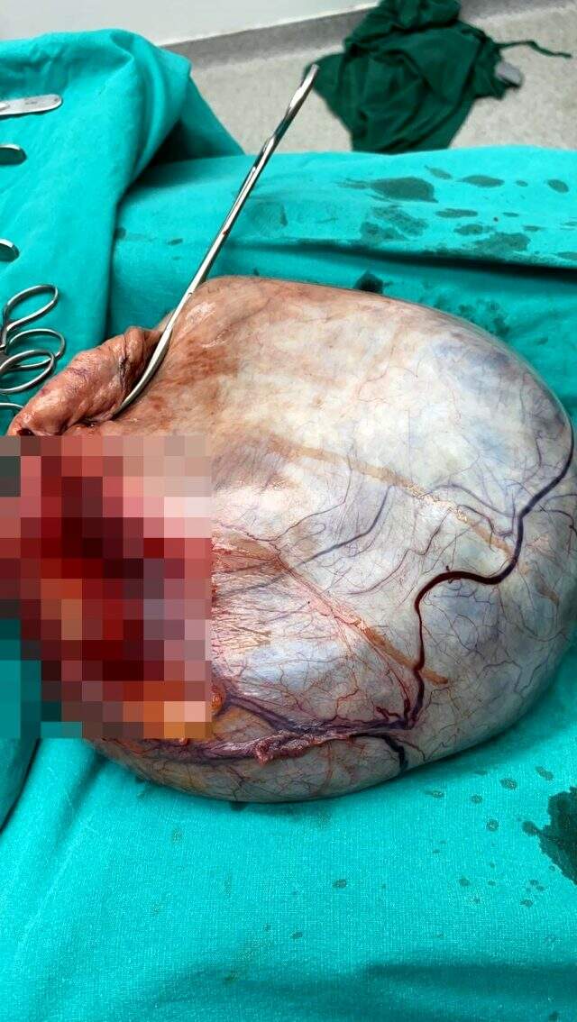 Doktorların bile hamile sandığı kadının karnından 6 kilogramlık kitle çıktı