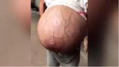 Karnında 20 kiloluk kütle taşıyan genç kadın tıp dünyasını şaşırttı Karnında 20 kiloluk kütle taşıyan genç kadın tıp dünyasını şaşırttı