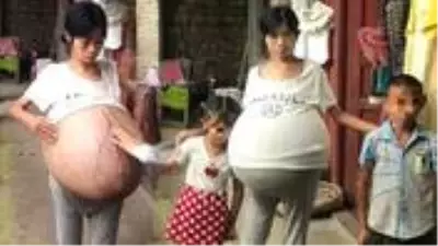 Karnında 20 kiloluk kütle taşıyan genç kadın tıp dünyasını şaşırttı Karnında 20 kiloluk kütle taşıyan genç kadın tıp dünyasını şaşırttı
