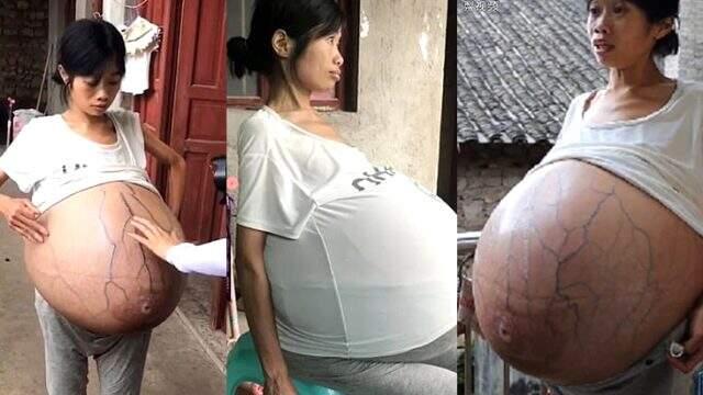 Karnında 20 kiloluk kütleli genç kadın tıp dünyasını şaşırttı Karnında 20 kiloluk kütleli genç kadın tıp dünyasını şaşırttı