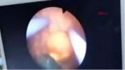 Çin'de şiddetli ağrı şikayetiyle hastaneye giden bir kişinin penisinden 29 adet bilye çıktı. Çin'de şiddetli ağrı şikayetiyle hastaneye giden bir kişinin penisinden 29 adet bilye çıktı.