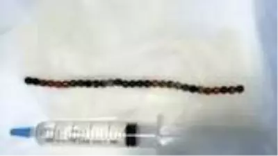 Şiddetli ağrı şikayetiyle hastaneye giden adamın cinsel organından 29 adet bilye çıktı Şiddetli ağrı şikayetiyle hastaneye giden adamın cinsel organından 29 adet bilye çıktı