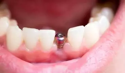 Diş implantı kanser yapar mı? Diş implantı kanser yapar mı?