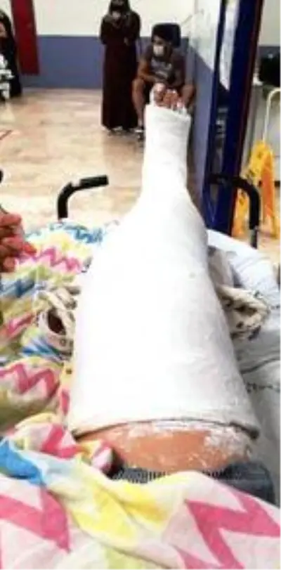 Talihsiz kadın, mazgal kapağındaki kırık nedeniyle bacağından oluyordu Talihsiz kadın, mazgal kapağındaki kırık nedeniyle bacağından oluyordu
