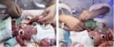 70 milyonda bir gerçekleşiyor! Üç kez düşük yapan kadın, dördüz doğurdu 70 milyonda bir gerçekleşiyor! Üç kez düşük yapan kadın, dördüz doğurdu