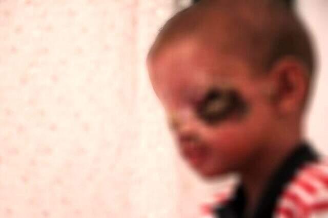 Cilt kanseri olduğu için güneşe çıkamayan 8 yaşındaki Salih'in tedavisi başladı