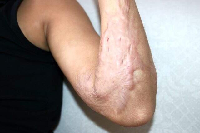 Vücudunun büyük kısmı yanan 11 yaşındaki kız çocuğu kimse yanına oturmadığı için yardım istiyor