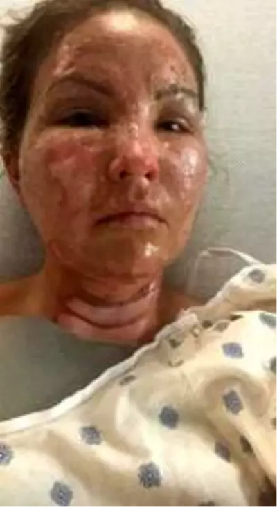 Yanan mum ile temas eden dezenfektan kutusu patladı, talihsiz kadın alevler içinde kaldı Yanan mum ile temas eden dezenfektan kutusu patladı, talihsiz kadın alevler içinde kaldı