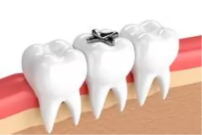 Siyah (amalgam) Dolgular Siyah (amalgam) Dolgular