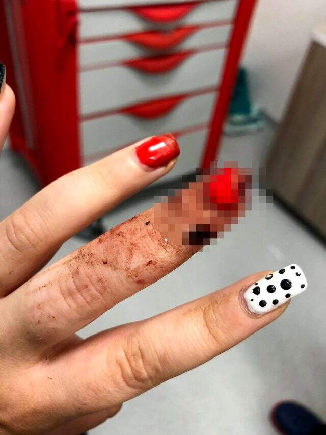 Yemek yemek için gittiği köftecide parmağı koptu